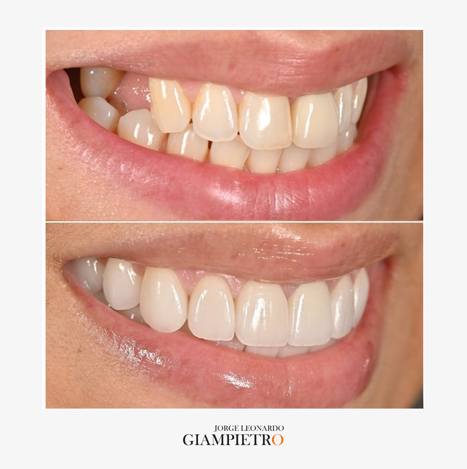 Implante Dental Exitoso