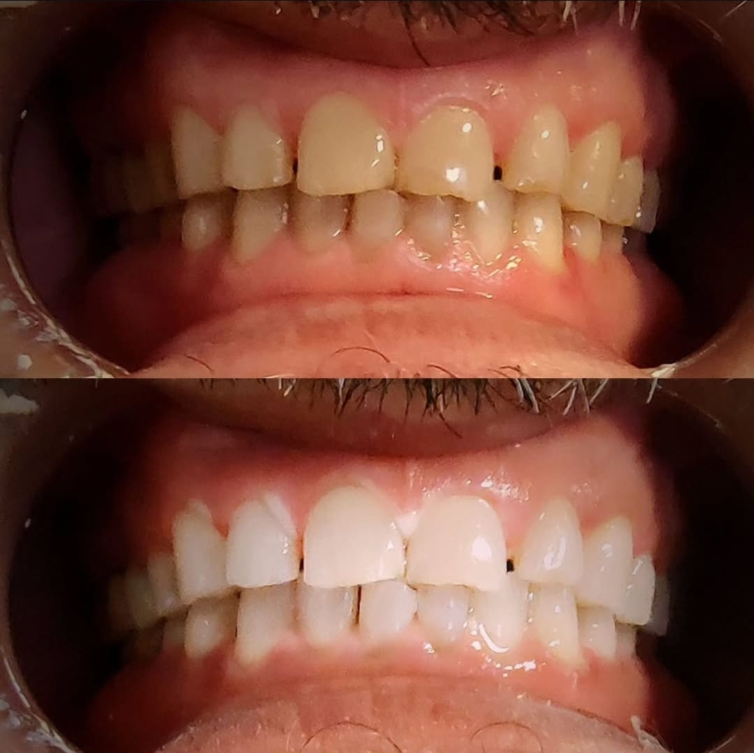Resultados de blanqueamiento dental