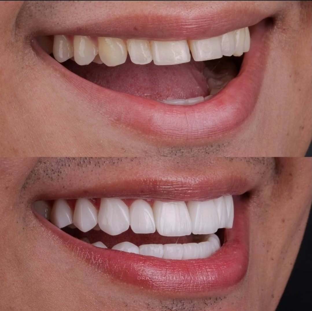 Sonrisa renovada con carillas